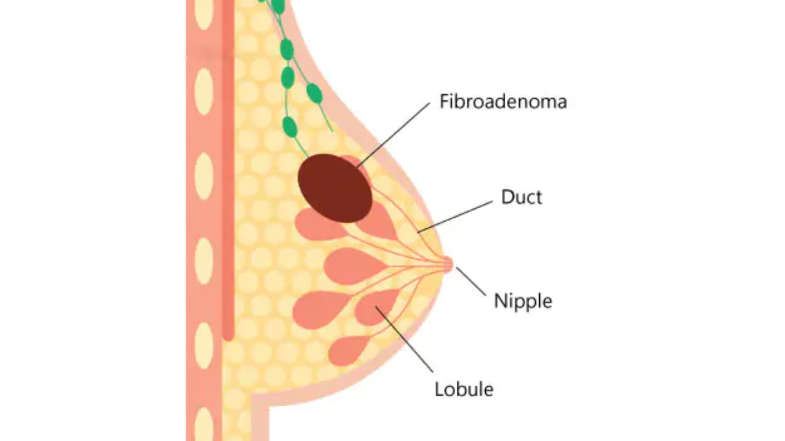 Breast Fibroadenoma: Symptoms, Treatment & Removal