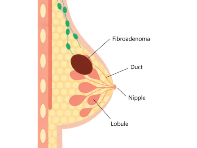 best-fibroadenoma-removal-surgeon-in-kolkata
