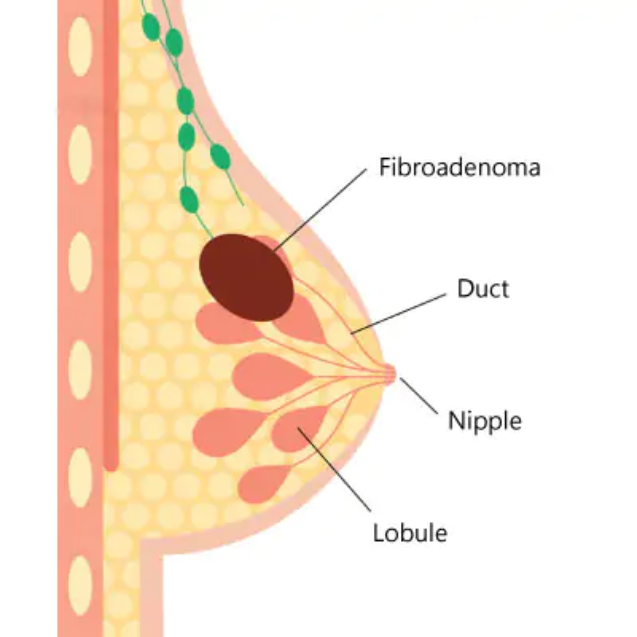 best-fibroadenoma-removal-surgeon-in-kolkata