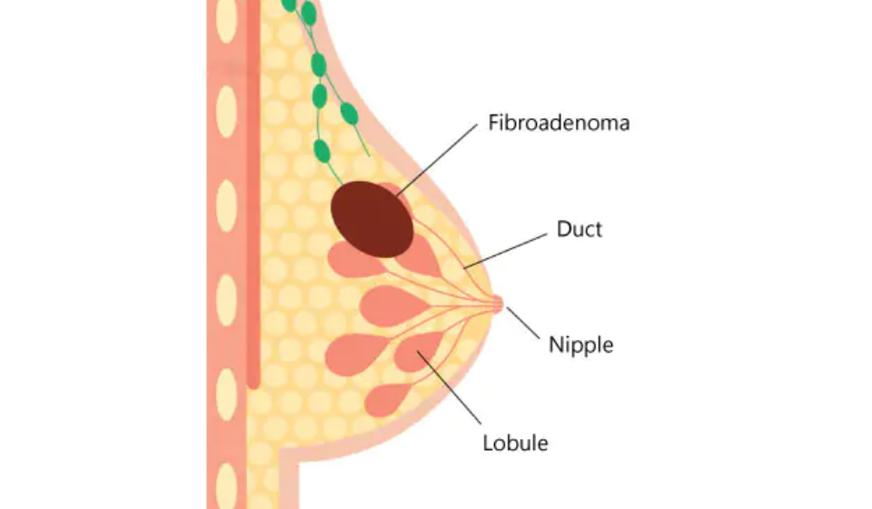 best-fibroadenoma-removal-surgeon-in-kolkata