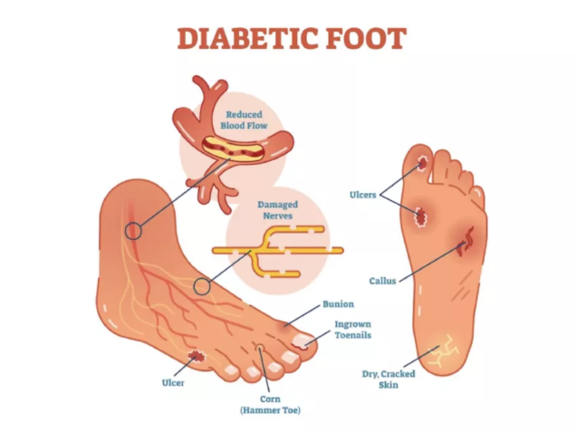 diabetic-foot