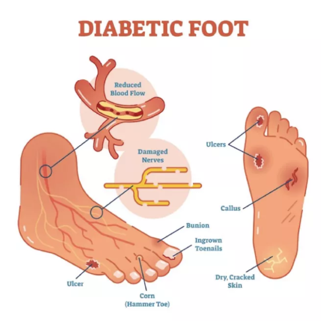 diabetic-foot