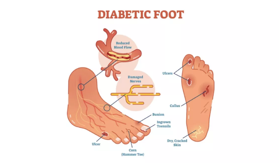 diabetic-foot